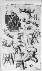 Kirurgiska ingrepp på det kvinnliga och manliga könet. Gravyr i "Armamentarium Surgical" av J. Scultetus, Venedig