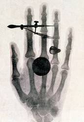 Wilhelm Röntgens röntgenbild av sin hustrus hand, 1896